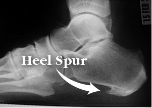 heel spur
